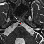 Subsequent MRI nicely shows the T2 hyperintense cystic mass in the right-eccentric clivus (white arrows) and the associated posteriorly directed osseous stalk (red arrow)