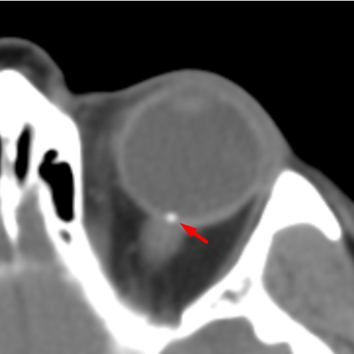 Optic Disc Drusen