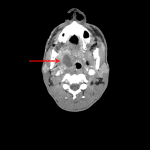 Right peritonsillar abscess (red arrow) with associated mass effect on the right eccentric oropharynx.