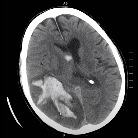 Approach to Head CT and Brain MRI (VIDEO)