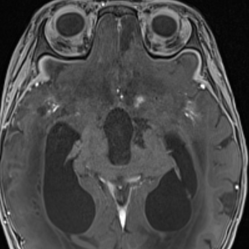 Labyrinthitis ossificans