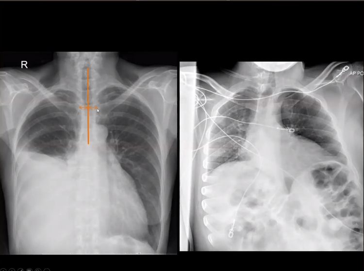 Chest Radiograph Pre-Workshop (VIDEO)