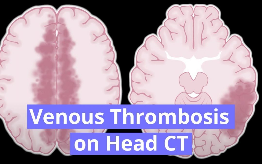 Cerebral Venous Thrombosis Video