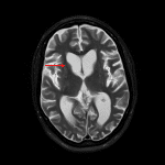 Marked striatal atrophy including atrophy of the caudate head resulting in box-shaped ex vacuo enlargement of the frontal horns of the lateral ventricles (red arrow), which is a typical imaging appearance for Huntington disease.