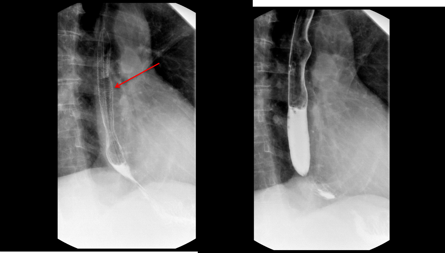 Esophagram shows fine circumferential folds (arrow) which do not persist and are not seen on the subsequent image.