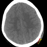 Scalp hematoma with distinct deep (red arrow) and superficial (yellow arrow) components. The deep component contains layering hyperdense blood products and is likely subgaleal in location.