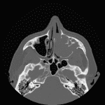 Inverted Papilloma