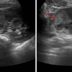 Wedge-shaped areas of parenchymal hyperechogenicity in the right kidney (red arrows), concerning for pyelonephritis.