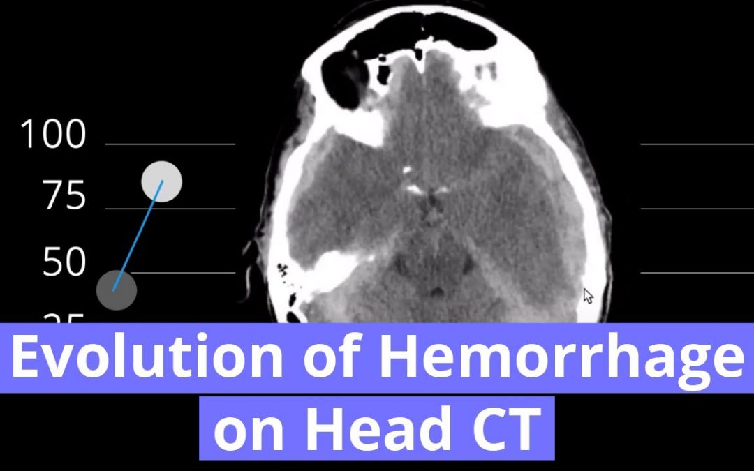 Evolution of Hemorrhage on Head CT