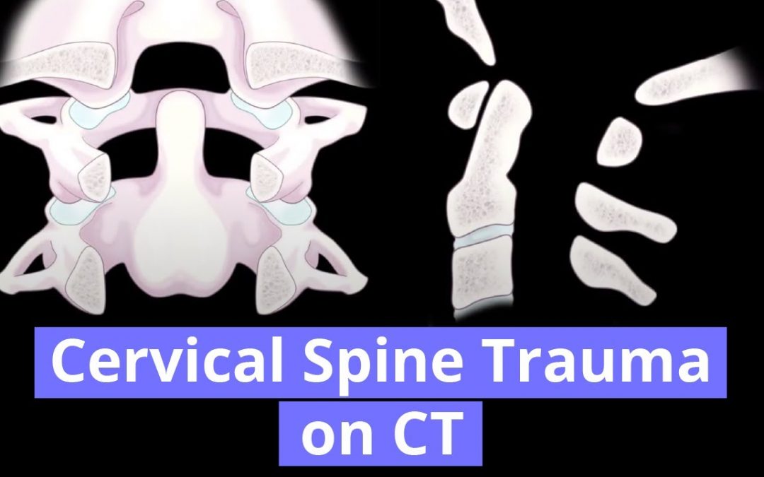 Cervical Spine Trauma