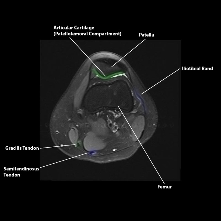 knee anatomy mri