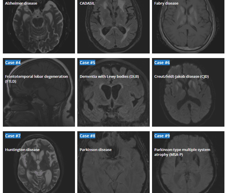 Neurodegenerative