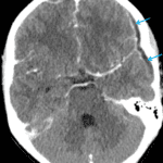 Peripherally-enhancing epidural collection (red arrows) with adjacent peripherally-enhancing subdural collections along the left greater than right frontal convexities (blue arrows).