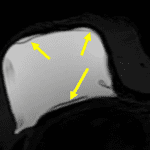 MRI STIR with water suppression sequence demonstrates signs of intracapsular rupture, including the subcapsular line sign (yellow arrows).