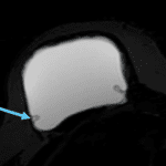 MRI STIR with water suppression sequence demonstrates signs of intracapsular rupture, including the keyhole sign (blue arrow).