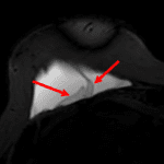 MRI STIR with water suppression sequence demonstrates signs of intracapsular rupture, including the linguini sign (red arrows).